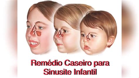 como tratar sinusite infantil
